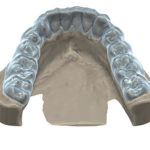 Module-Gouttiere-dentaire